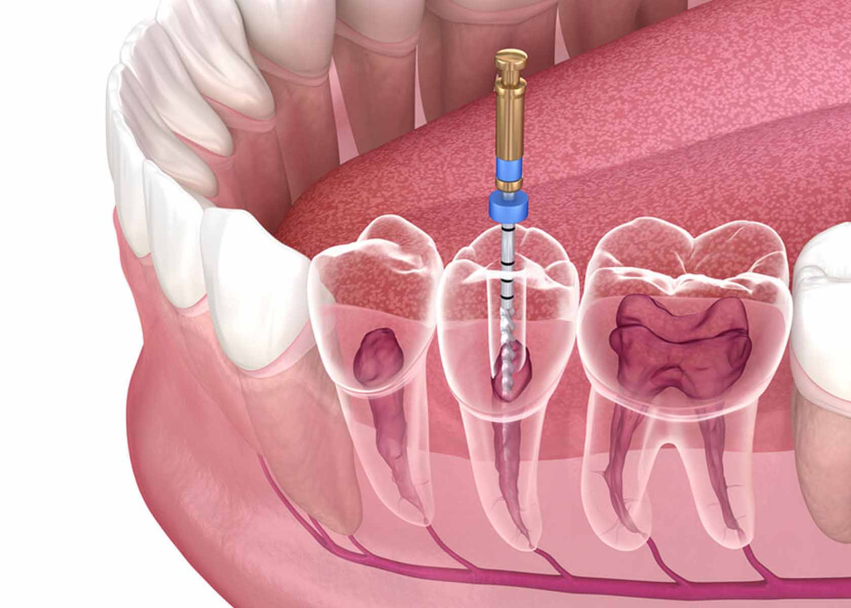 Illustrazione di inserimento di impianto dentale